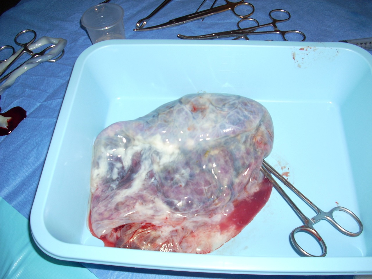 placenta, umbilical cord, birth-202640.jpg